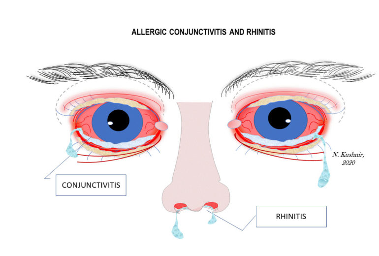 Allergic Pink Eye