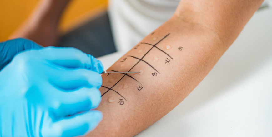 Skin Prick Allergy Testing