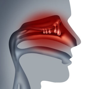 Nasal polyps medical concept as noncancerous swelling and growth as a human sinuses congestion symptom symbol in a 3D illustration style.